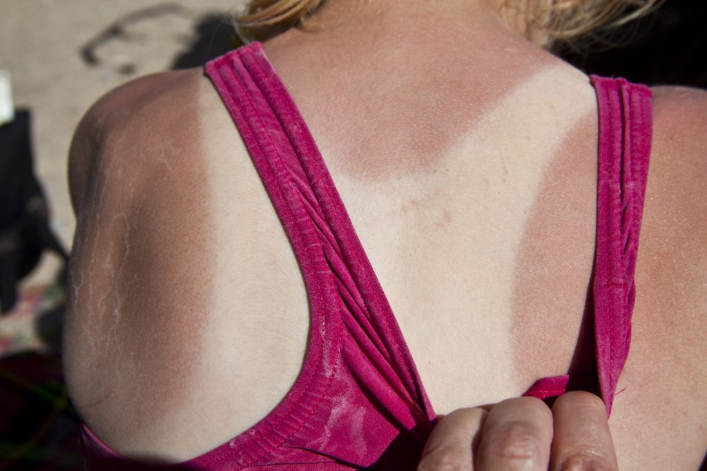 Showing tan lines left by swimming costume.